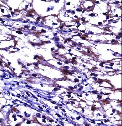 TNFRSF11B Antibody immunohistochemistry of formalin-fixed and paraffin-embedded human kidney carcinoma followed by peroxidase-conjugated secondary antibody and DAB staining.