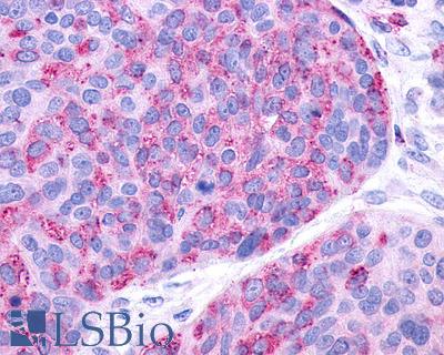 Anti-P2Y10 / P2RY10 antibody IHC of human Ovary, Carcinoma. Immunohistochemistry of formalin-fixed, paraffin-embedded tissue after heat-induced antigen retrieval.