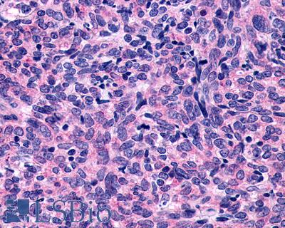 Anti-P2Y10 / P2RY10 antibody IHC of human Lung, Small Cell Carcinoma. Immunohistochemistry of formalin-fixed, paraffin-embedded tissue after heat-induced antigen retrieval.