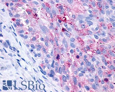 Anti-P2Y10 / P2RY10 antibody IHC of human Ovary, Carcinoma. Immunohistochemistry of formalin-fixed, paraffin-embedded tissue after heat-induced antigen retrieval.