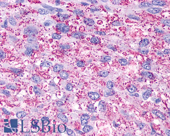 Anti-P2Y13 / P2RY13 antibody IHC of human Brain, Glioblastoma. Immunohistochemistry of formalin-fixed, paraffin-embedded tissue after heat-induced antigen retrieval.