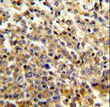 Formalin-fixed and paraffin-embedded human lymphoma reacted with NCF4 Antibody , which was peroxidase-conjugated to the secondary antibody, followed by DAB staining. This data demonstrates the use of this antibody for immunohistochemistry; clinical relevance has not been evaluated.