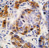 Formalin-fixed and paraffin-embedded human hepatocarcinoma tissue reacted with ALDH4A1 antibody , which was peroxidase-conjugated to the secondary antibody, followed by DAB staining. This data demonstrates the use of this antibody for immunohistochemistry; clinical relevance has not been evaluated.
