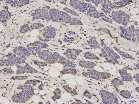 Immunohistochemistry of paraffin-embedded human breast cancer using ALDH4A1 antibody at dilution of 1:200 (200x lens).