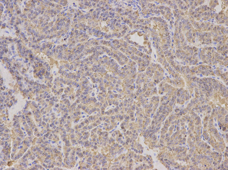 Immunohistochemistry of paraffin-embedded human thyroid cancer using ALDH4A1 antibody at dilution of 1:200 (200x lens).