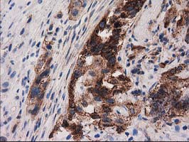 IHC of paraffin-embedded Carcinoma of Human bladder tissue using anti-PYCR2 mouse monoclonal antibody.