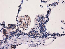 IHC of paraffin-embedded Carcinoma of Human lung tissue using anti-PYCR2 mouse monoclonal antibody.