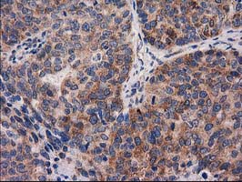 IHC of paraffin-embedded Adenocarcinoma of Human ovary tissue using anti-PYCR2 mouse monoclonal antibody.