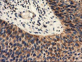 IHC of paraffin-embedded Carcinoma of Human bladder tissue using anti-PYCR2 mouse monoclonal antibody.
