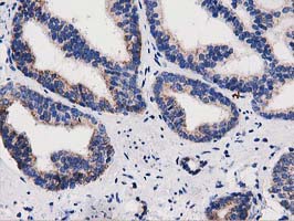 IHC of paraffin-embedded Carcinoma of Human prostate tissue using anti-PYCR2 mouse monoclonal antibody.