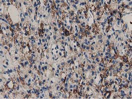 IHC of paraffin-embedded Carcinoma of Human kidney tissue using anti-PYCR2 mouse monoclonal antibody.