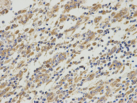 Immunohistochemistry of paraffin-embedded human stomach cancer using PA2G4 antibody at dilution of 1:200 (400x lens).