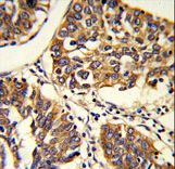 Formalin-fixed and paraffin-embedded human lung carcinoma reacted with PABPC1 Antibody , which was peroxidase-conjugated to the secondary antibody, followed by DAB staining. This data demonstrates the use of this antibody for immunohistochemistry; clinical relevance has not been evaluated.