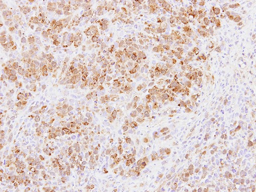 IHC of paraffin-embedded SCM1 xenograft using PABPC3 antibody at 1:100 dilution.