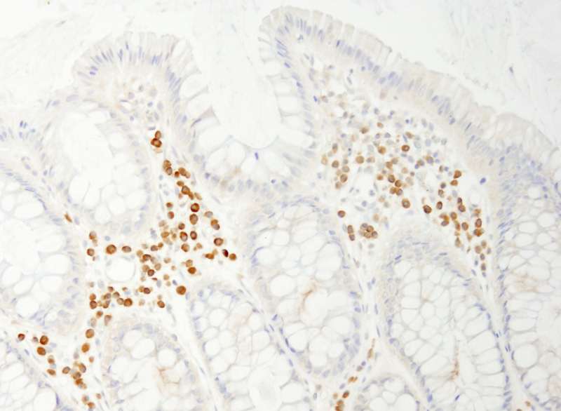 Detection of Human PABP4 by Immunohistochemistry. Sample: FFPE section of human colon carcinoma. Antibody: Affinity purified rabbit anti-PABP4 used at a dilution of 1:200 (1 ug/ml). Detection: DAB.