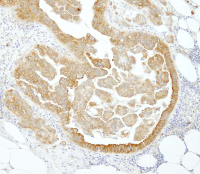 Detection of Human PABP4 by Immunohistochemistry. Sample: FFPE section of human ovarian carcinoma. Antibody: Affinity purified rabbit anti-PABP4 used at a dilution of 1:250.