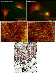 Formalin-fixed and paraffin-embedded human cancer tissue reacted with the primary antibody, which was peroxidase-conjugated to the secondary antibody, followed by DAB staining. This data demonstrates the use of this antibody for immunohistochemistry; clinical relevance has not been evaluated. BC = breast carcinoma; HC = hepatocarcinoma.