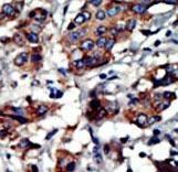 Formalin-fixed and paraffin-embedded human cancer tissue reacted with the primary antibody, which was peroxidase-conjugated to the secondary antibody, followed by AEC staining. This data demonstrates the use of this antibody for immunohistochemistry; clinical relevance has not been evaluated. BC = breast carcinoma; HC = hepatocarcinoma.