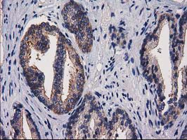 IHC of paraffin-embedded Carcinoma of Human prostate tissue using anti-PACSIN3 mouse monoclonal antibody.