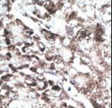 Formalin-fixed and paraffin-embedded human cancer tissue reacted with the primary antibody, which was peroxidase-conjugated to the secondary antibody, followed by DAB staining. This data demonstrates the use of this antibody for immunohistochemistry; clinical relevance has not been evaluated. BC = breast carcinoma; HC = hepatocarcinoma.