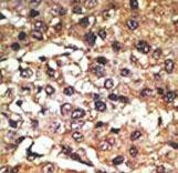 Formalin-fixed and paraffin-embedded human cancer tissue reacted with the primary antibody, which was peroxidase-conjugated to the secondary antibody, followed by DAB staining. This data demonstrates the use of this antibody for immunohistochemistry; clinical relevance has not been evaluated. BC = breast carcinoma; HC = hepatocarcinoma.