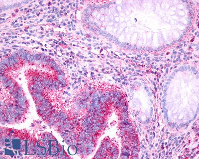 Anti-PAEL Receptor / GPR37 antibody IHC of human Colon, Carcinoma. Immunohistochemistry of formalin-fixed, paraffin-embedded tissue after heat-induced antigen retrieval.