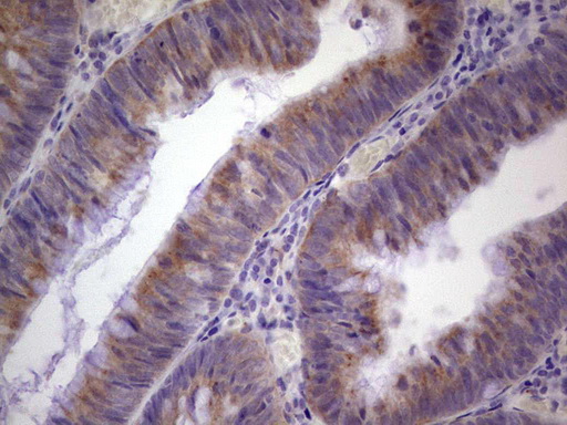 IHC of paraffin-embedded Adenocarcinoma of Human colon tissue using anti-PAGE1 mouse monoclonal antibody. (Heat-induced epitope retrieval by 1 mM EDTA in 10mM Tris, pH8.5, 120°C for 3min).