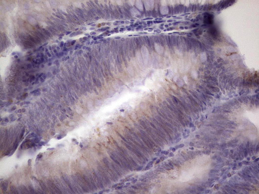 IHC of paraffin-embedded Adenocarcinoma of Human colon tissue using anti-PAGE1 mouse monoclonal antibody. (Heat-induced epitope retrieval by 1 mM EDTA in 10mM Tris, pH8.5, 120°C for 3min).