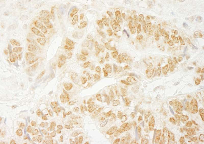 Detection of Human PA1 by Immunohistochemistry. Sample: FFPE section of human colon carcinoma. Antibody: Affinity purified rabbit anti-PA1 used at a dilution of 1:1000 (1 ug/ml). Detection: DAB.