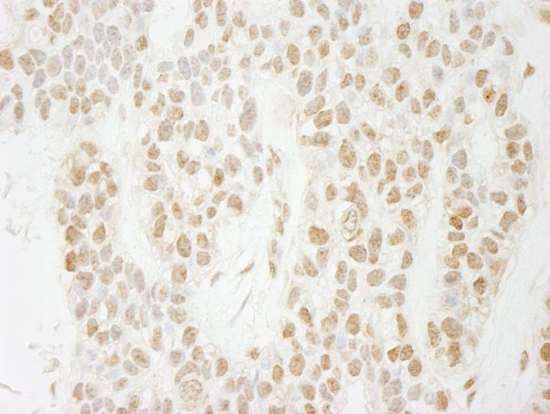 Detection of Human PA1 by Immunohistochemistry. Sample: FFPE section of human breast carcinoma. Antibody: Affinity purified rabbit anti-PA1 used at a dilution of 1:250.