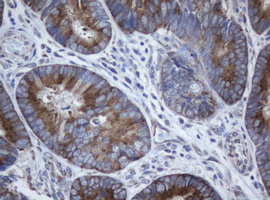 IHC of paraffin-embedded Adenocarcinoma of Human colon tissue using anti-SERBP1 mouse monoclonal antibody.