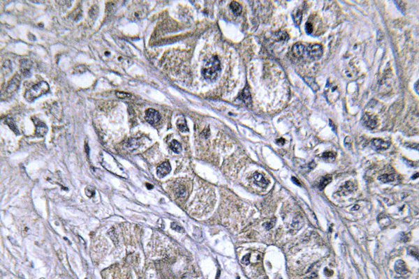 IHC of PAI-3 (L291) pAb in paraffin-embedded human liver carcinoma.