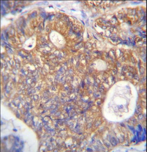 PAICS Antibody immunohistochemistry of formalin-fixed and paraffin-embedded human colon carcinoma followed by peroxidase-conjugated secondary antibody and DAB staining.