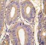 Formalin-fixed and paraffin-embedded human colon carcinoma tissue reacted with PAK1 Antibody (T423) , which was peroxidase-conjugated to the secondary antibody, followed by DAB staining. This data demonstrates the use of this antibody for immunohistochemistry; clinical relevance has not been evaluated.