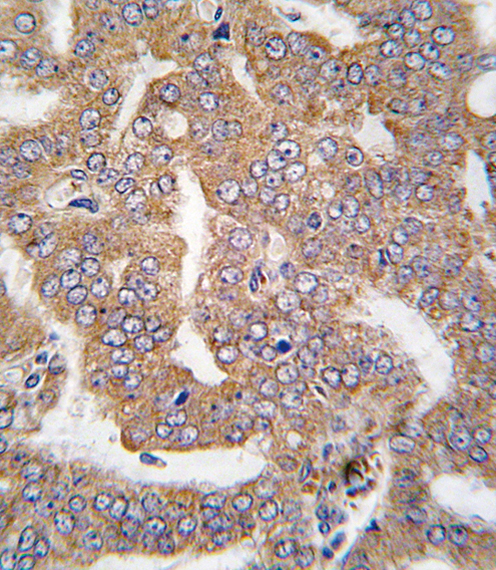 Formalin-fixed and paraffin-embedded human prostate carcinoma tissue reacted with PAK4 antibody , which was peroxidase-conjugated to the secondary antibody, followed by DAB staining. This data demonstrates the use of this antibody for immunohistochemistry; clinical relevance has not been evaluated.