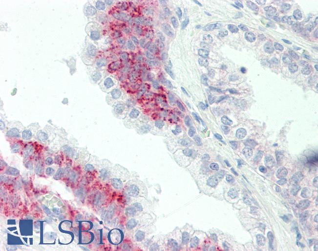 Anti-PAK4 antibody IHC staining of human prostate. Immunohistochemistry of formalin-fixed, paraffin-embedded tissue after heat-induced antigen retrieval. Antibody LS-B10177 dilution 1:100.