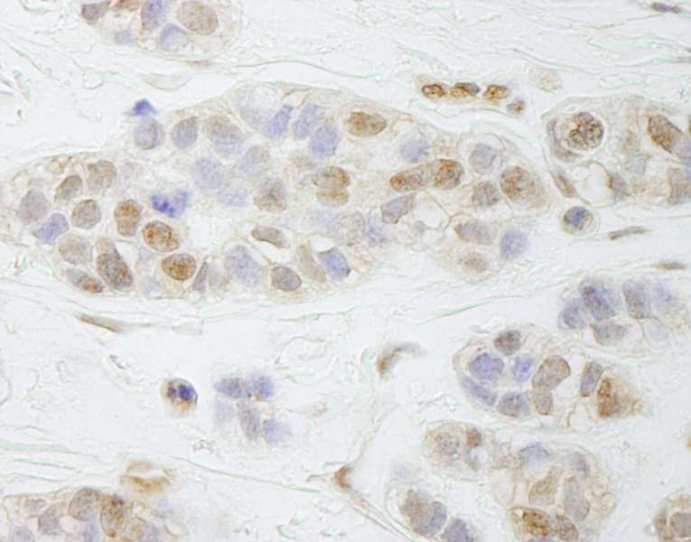 Detection of Human PALB2 by Immunohistochemistry. Sample: FFPE section of human breast carcinoma. Antibody: Affinity purified rabbit anti-PALB2 used at a dilution of 1:250.