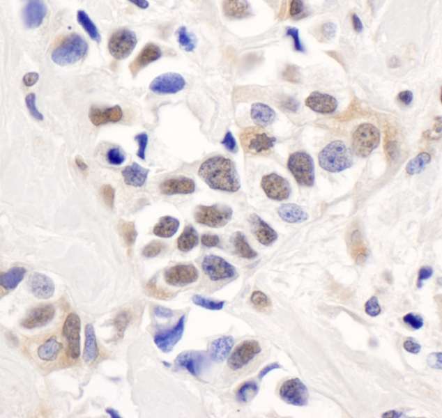 Detection of Human PALB2 by Immunohistochemistry. Sample: FFPE section of human breast carcinoma. Antibody: Affinity purified rabbit anti-PALB2 used at a dilution of 1:5000 (0.2 ug/ml). Detection: DAB.