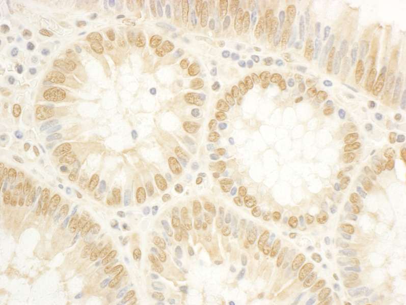 Detection of Human MPP6 by Immunohistochemistry. Sample: FFPE section of human colon carcinoma. Antibody: Affinity purified rabbit anti-MPP6 used at a dilution of 1:5000 (0.2 ug/ml). Detection: DAB.
