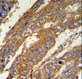 PAN3 Antibody IHC of formalin-fixed and paraffin-embedded human cervix carcinoma followed by peroxidase-conjugated secondary antibody and DAB staining.