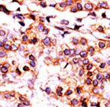 Formalin-fixed and paraffin-embedded human cancer tissue reacted with the primary antibody, which was peroxidase-conjugated to the secondary antibody, followed by AEC staining. This data demonstrates the use of this antibody for immunohistochemistry; clinical relevance has not been evaluated. BC = breast carcinoma; HC = hepatocarcinoma.