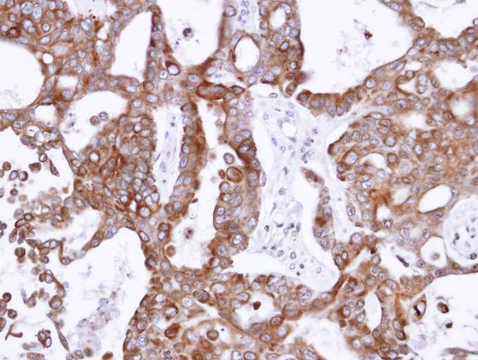 IHC of paraffin-embedded NCIN87 xenograft using PANK1 antibody at 1:500 dilution.
