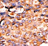 Formalin-fixed and paraffin-embedded human cancer tissue reacted with the primary antibody, which was peroxidase-conjugated to the secondary antibody, followed by AEC staining. This data demonstrates the use of this antibody for immunohistochemistry; clinical relevance has not been evaluated. BC = breast carcinoma; HC = hepatocarcinoma.