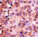 Formalin-fixed and paraffin-embedded human cancer tissue reacted with the primary antibody, which was peroxidase-conjugated to the secondary antibody, followed by AEC staining. This data demonstrates the use of this antibody for immunohistochemistry; clinical relevance has not been evaluated. BC = breast carcinoma; HC = hepatocarcinoma.