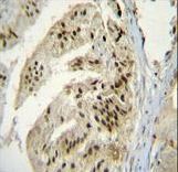 PAP Antibody immunohistochemistry of formalin-fixed and paraffin-embedded human prostate carcinoma followed by peroxidase-conjugated secondary antibody and DAB staining.