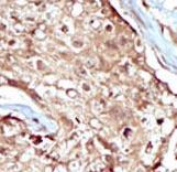 Formalin-fixed and paraffin-embedded human cancer tissue reacted with the primary antibody, which was peroxidase-conjugated to the secondary antibody, followed by AEC staining. This data demonstrates the use of this antibody for immunohistochemistry; clinical relevance has not been evaluated. BC = breast carcinoma; HC = hepatocarcinoma.