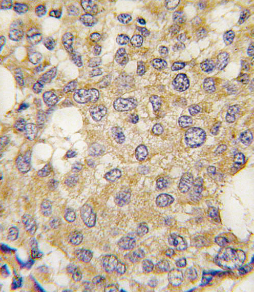Formalin-fixed and paraffin-embedded human breast carcinoma tissue reacted with Parg antibody , which was peroxidase-conjugated to the secondary antibody, followed by DAB staining. This data demonstrates the use of this antibody for immunohistochemistry; clinical relevance has not been evaluated.