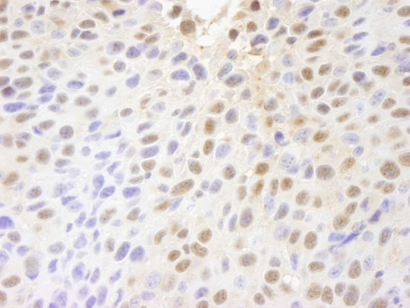 Detection of Mouse PARP10 by Immunohistochemistry. Sample: FFPE section of mouse squamous cell carcinoma. Antibody: Affinity purified rabbit anti-PARP10 used at a dilution of 1:250.