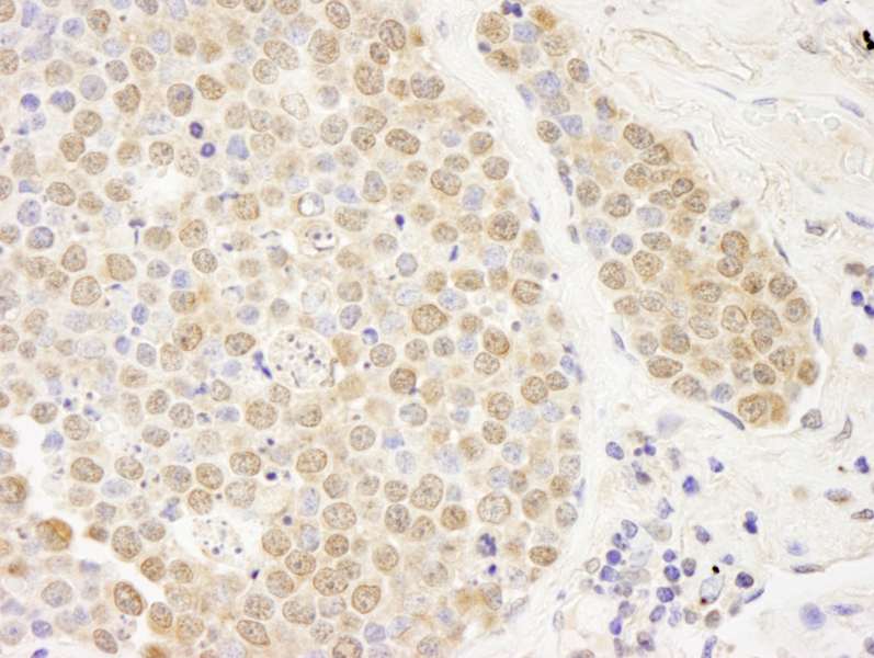 Detection of Human PARP10 by Immunohistochemistry. Sample: FFPE section of human small cell lung cancer. Antibody: Affinity purified rabbit anti-PARP10 used at a dilution of 1:250.