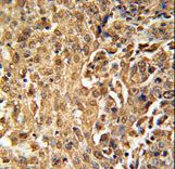 ZC3HAV1 Antibody immunohistochemistry of formalin-fixed and paraffin-embedded human cervix carcinoma followed by peroxidase-conjugated secondary antibody and DAB staining.